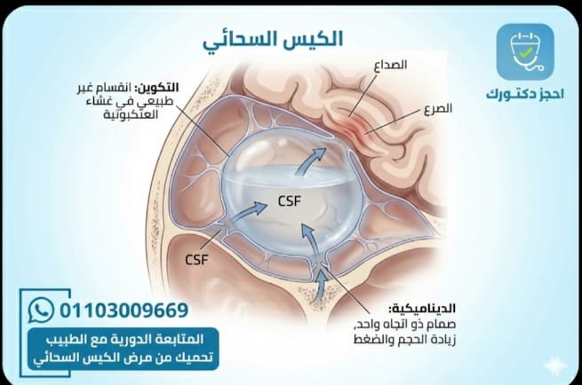توضح الصورة الكيس السحائي (Arachnoid Cyst) داخل الدماغ والحبل الشوكي، وهو كيس مملوء بالسائل النخاعي يتكوّن بين أغشية المخ (الأم العنكبوتية). يظهر بالرسم مكان الكيس داخل المخ وكيف يمكن أن يضغط على أنسجة الدماغ أو الأعصاب الشوكية، مما يؤدي إلى أعراض مثل الص