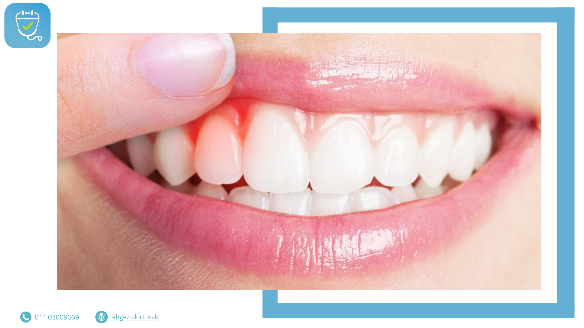 التهاب اللثة