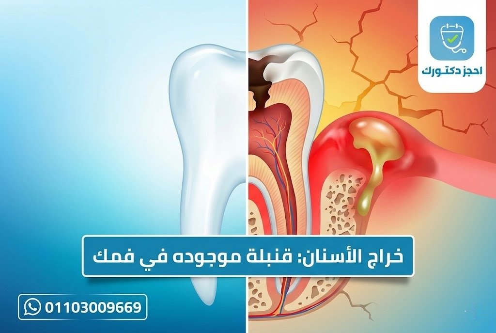 صورة توضيحية لدرس يحتوي على خراج سني واضح عند جذر السن، يظهر تورم واحمرار في اللثة مع تجمع صديدي أصفر حول منطقة الإصابة، مما يدل على وجود عدوى بكتيرية متقدمة داخل السن والأنسجة المحيطة به.